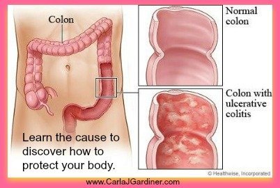 Learn the Cause of Ulcerative Colitis, Discover How to Protect Your Body
